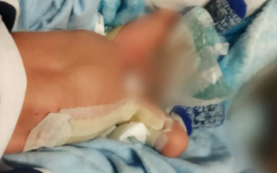 Família pede investigação da PF após bebê sofrer queimaduras em incubadora do HU de Dourados