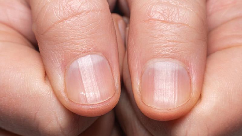Alerta: dermatologista revela o que podem significar riscos nas unhas
