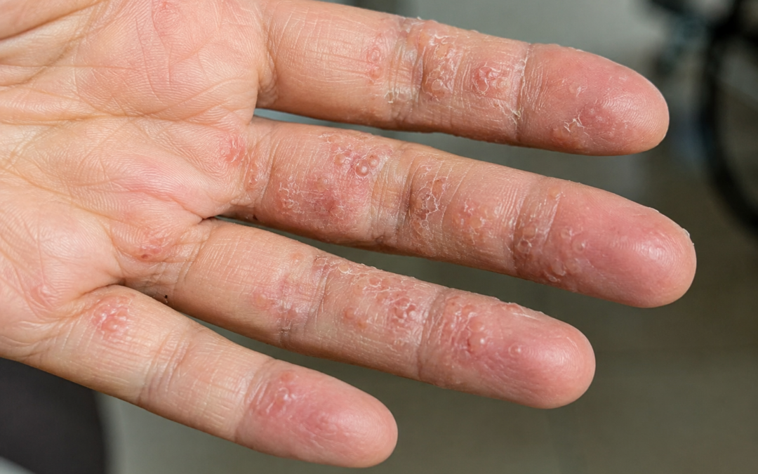 Ansiedade silenciosa: as marcas que ela pode deixar no seu rosto, mãos e corpo
